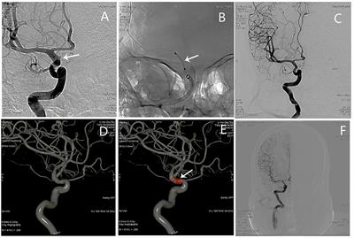 Application of the Willis Covered Stent in the Treatment of Blood Blister-Like Aneurysms: A Single-Center Experience